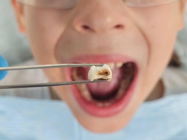 Best Dentist for Tooth Abscess  in Fletcher, OK